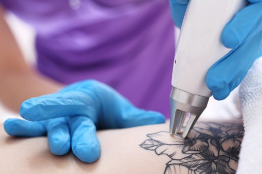 Symbolbild Tattoo entfernen Hausmittel: Ein Laser wird auf die Haut gesetzt, um ein Blumentattoo zu entfernen. 